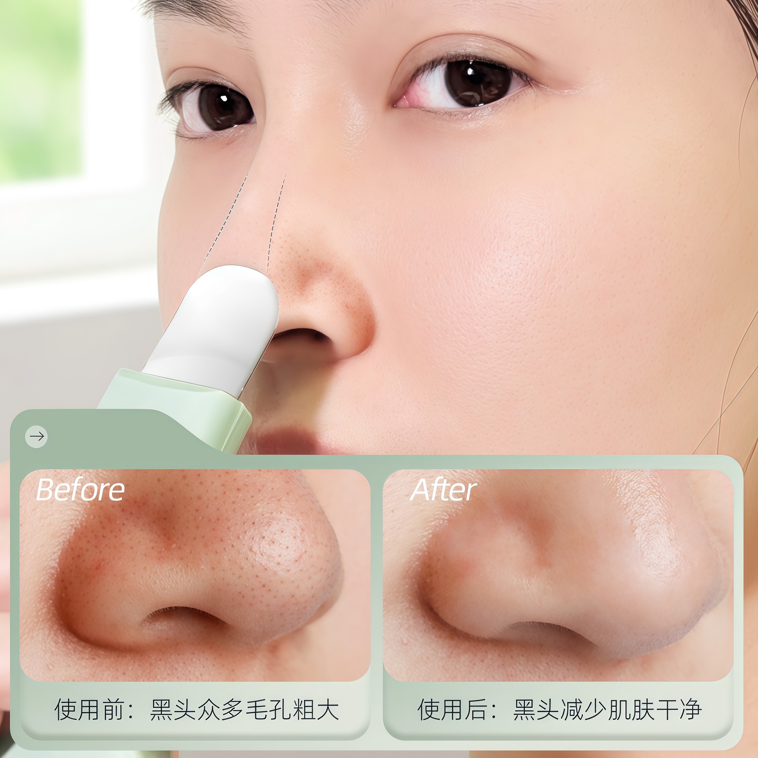 人体工学手动黑头铲刮黑头粉刺神器超薄脸部毛孔清洁皮铲美院同款,淘宝优惠券,粉丝福利购,淘宝优惠卷