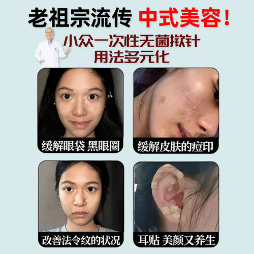 玉女十三针揿针穴位贴医院同款面部美容法令纹家用版中式针灸贴cl - 图0