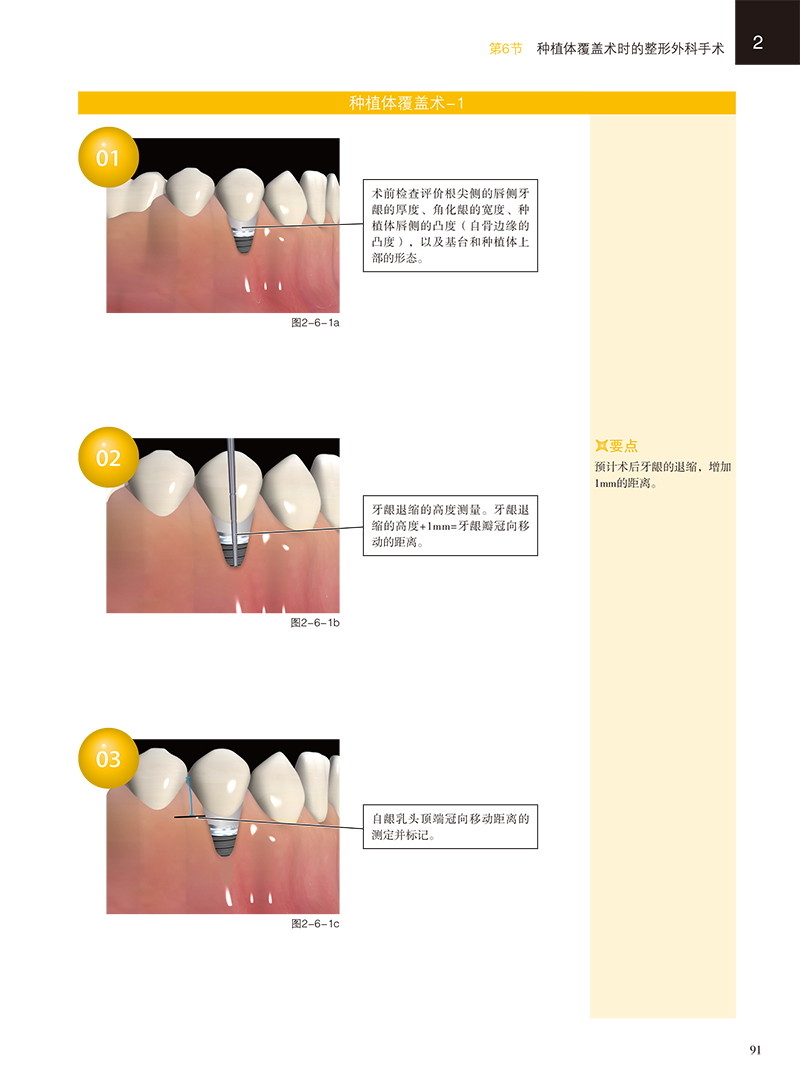 现货3D牙周美容手术图谱 种植 桥体篇配有真实的临床病例口腔种植医生的手边书冈田素平太等编著9787559117243T辽宁科学技术出版社 - 图2