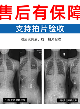私人定制儿童学生脊柱侧弯支具