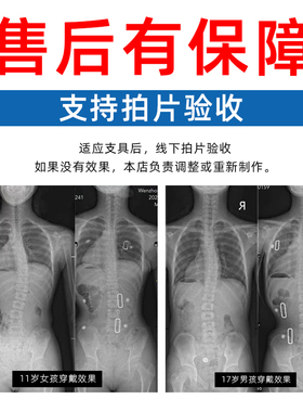 私人定制儿童学生脊柱侧弯支具