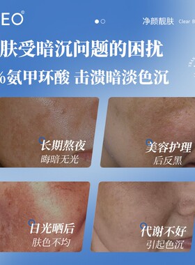 烟酰胺精华液传明酸氨甲环酸精华水光项目反黑改善暗黄色沉斑修护