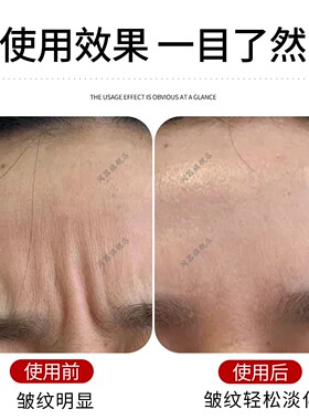 川字纹固定器淡化眉间贴法令纹额头贴提拉紧致睡觉专用防皱眉神器