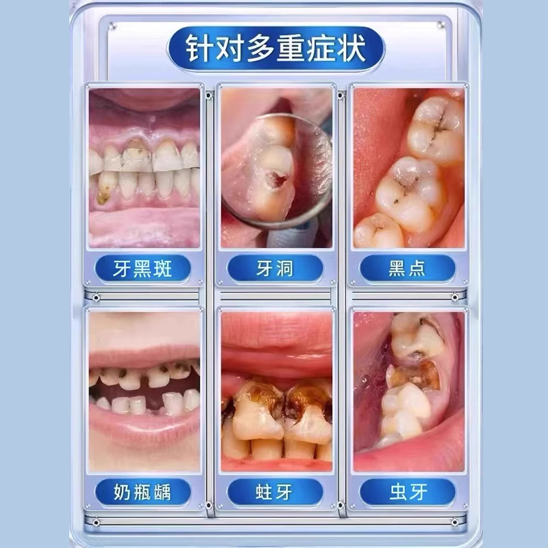 牙膏防蛀牙抗敏含氟成人蛀牙专用龋齿牙洞清理牙虫的可搭配药膏RQ - 图0