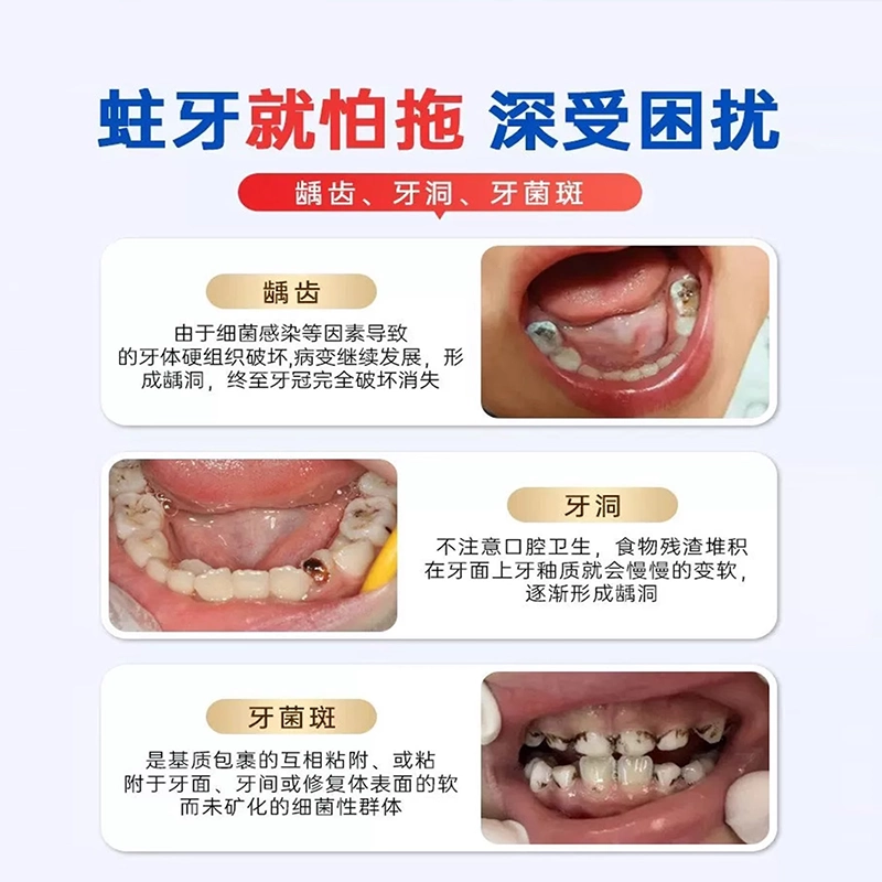 儿童蛀牙牙洞清理牙虫的牙齿防龋凝胶去黑线黑渍牙窝沟药房同售DS,淘宝优惠券,粉丝福利购,淘宝优惠卷