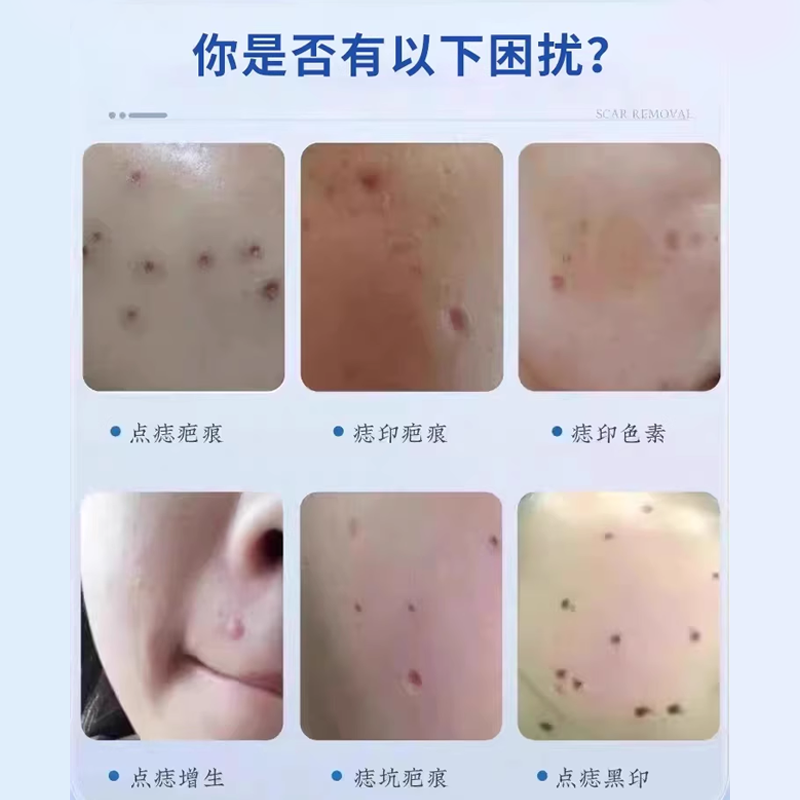 点痣后去疤痕修复膏除疤膏点斑去红印生长因子凝胶消印凹陷性TO