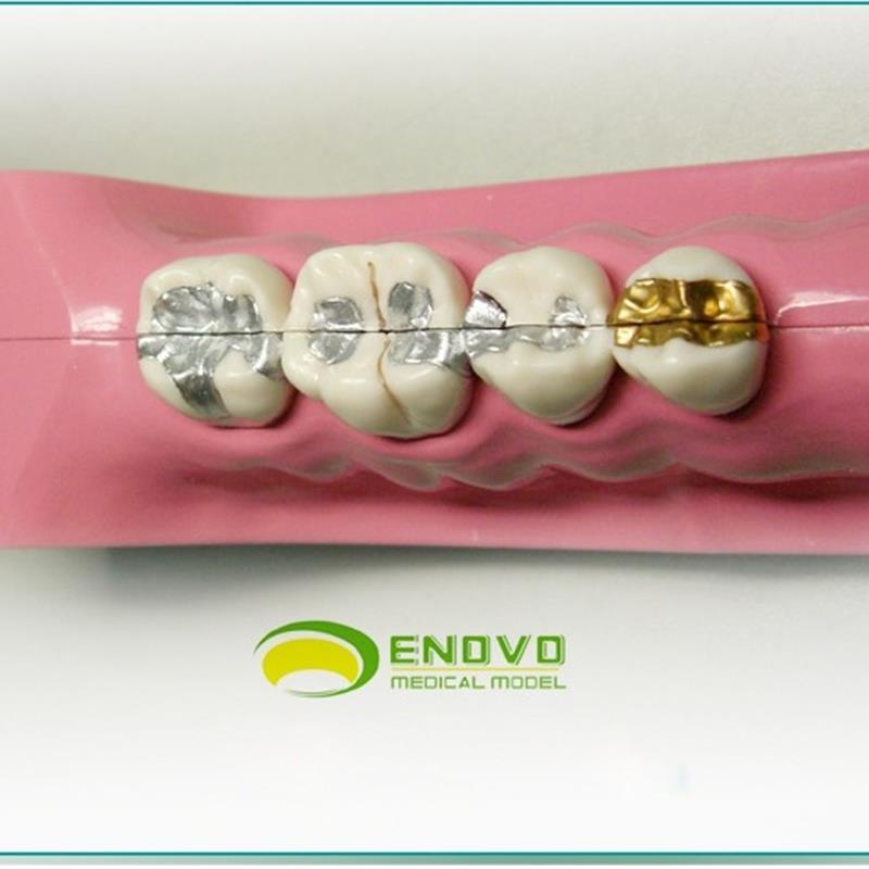 ENOVO颐诺右j下后牙组织分解模型牙齿解剖牙列模型口腔齿科科教学 - 图1