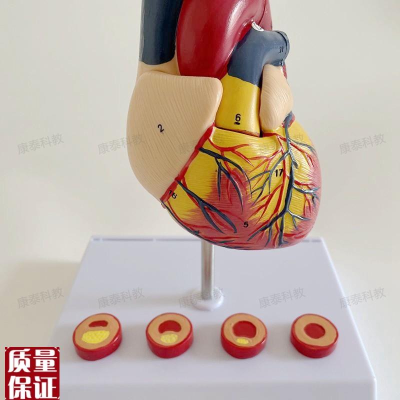 康泰模型a心血管粥样硬化狭窄阻塞病理冠状动脉临床医药促销人体 - 图2