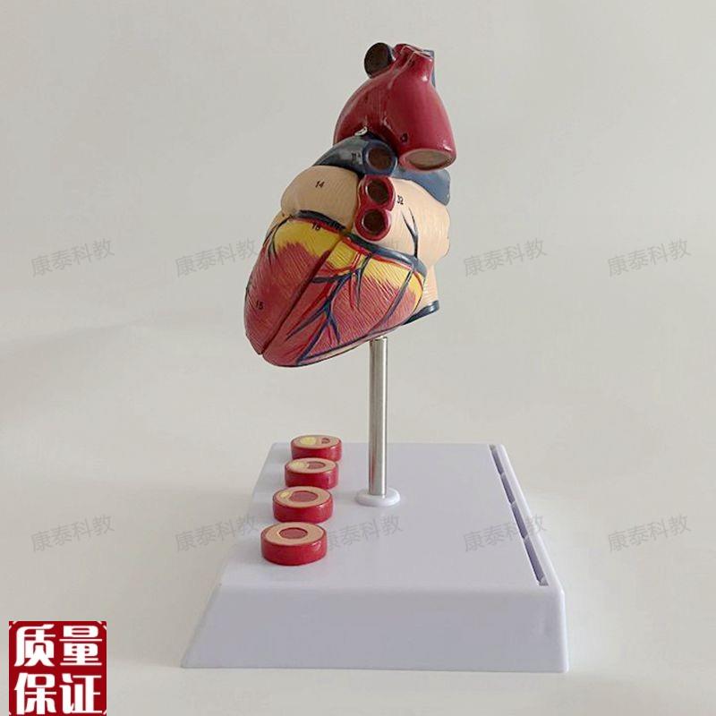 康泰模型a心血管粥样硬化狭窄阻塞病理冠状动脉临床医药促销人体 - 图1