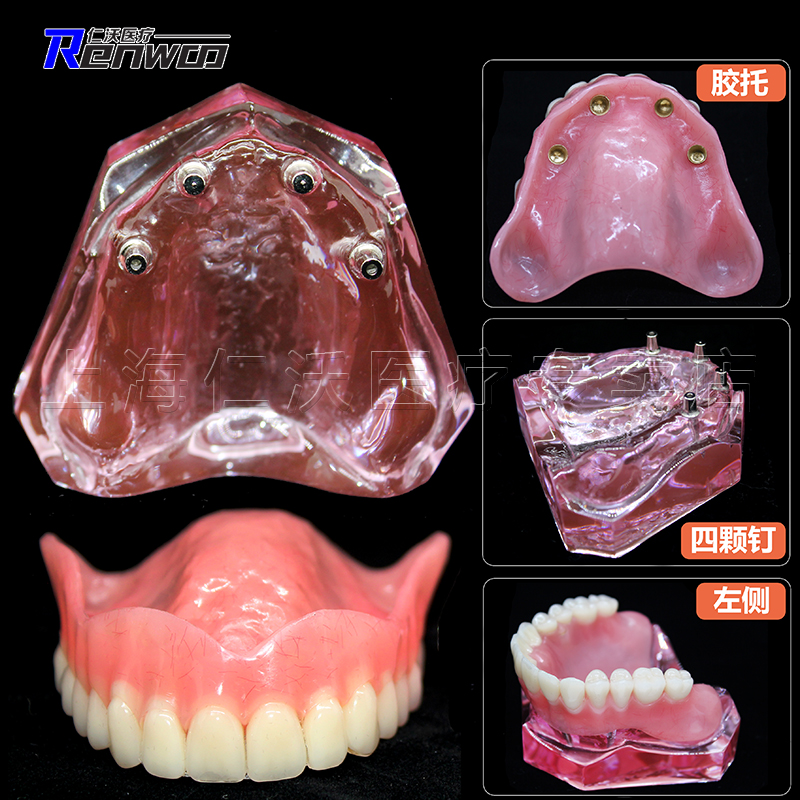 牙科模型 活动牙模型 吸附性义齿 种植杆卡 口腔牙模型 全口假牙 - 图1