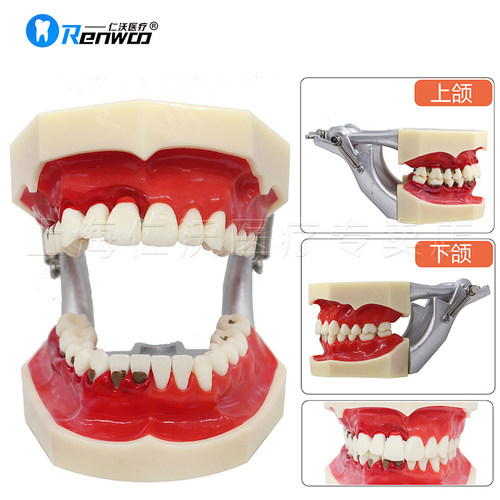 牙科模型 活动牙模型 吸附性义齿 种植杆卡 口腔牙模型 全口假牙 - 图2