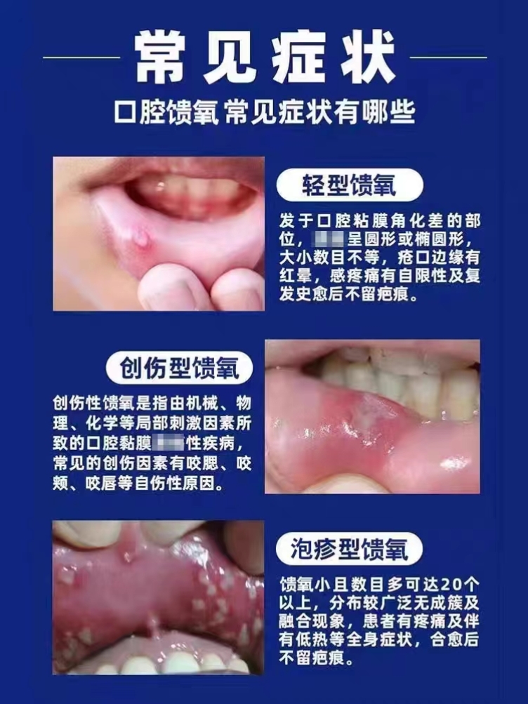 嘴巴口腔上火起泡烂舌头口腔内壁起泡白点口疮疼痛养护粘膜止痛喷 - 图1