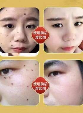 点痣膏无痕正品旗舰店祛脸部黑痣痦子药水美容院不留疤专用修复液