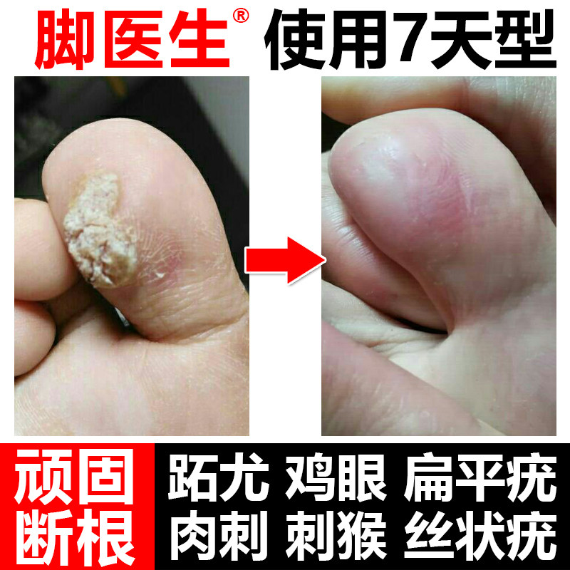 脚医生跖疣净膏贴扁平疣去疣灵鸡眼 drjys针灸器具（器械）