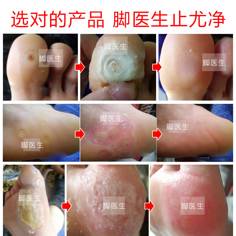 脚医生止尤净跖疣鸡眼药足部去疣灵 drjys浴足剂