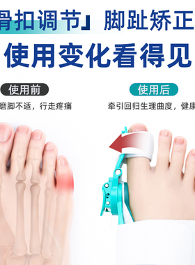 脚部儿童成人纠正器脚趾骨头突出
