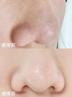 韩国直邮  ONE-DAY'S YOU去黑头水导出精华液喷雾草莓鼻收缩毛孔