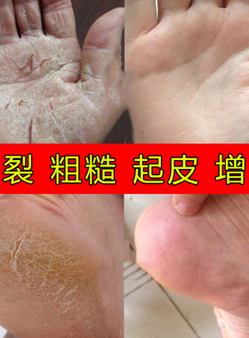 秋冬干燥粗糙女手足粗糙手足霜