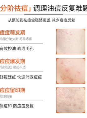皮宝战痘修护套装清爽控油65g