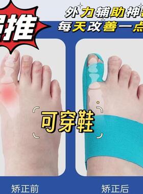 女士治疗拇外翻矫正器肌贴青少年