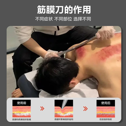 筋膜刀自用专业级全套探扫刀蝙蝠鲨鱼刀肌肉放松五行体龄小号316 - 图3