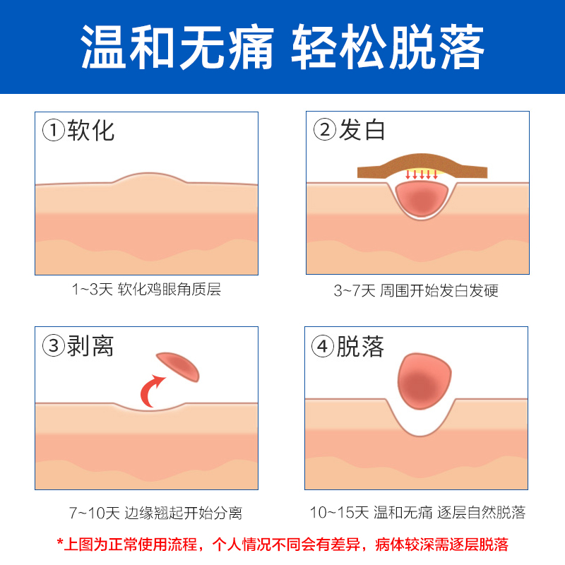 德国正品洁沃Gehwol鸡眼贴老茧脚趾无痛去鸡贴眼硬茧脚底鸡眼膏 - 图1