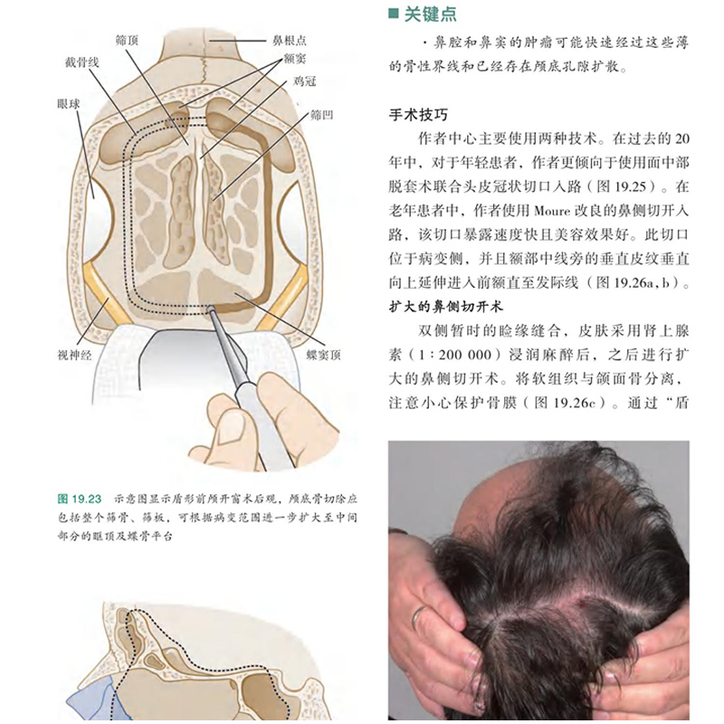 正版现货 鼻腔鼻窦鼻咽肿瘤 石照辉主译 肿瘤病理发病原因病理生理上颌手术鼻窦手术耳鼻咽喉头颈外科医学书籍 世界图书出版公司 - 图1