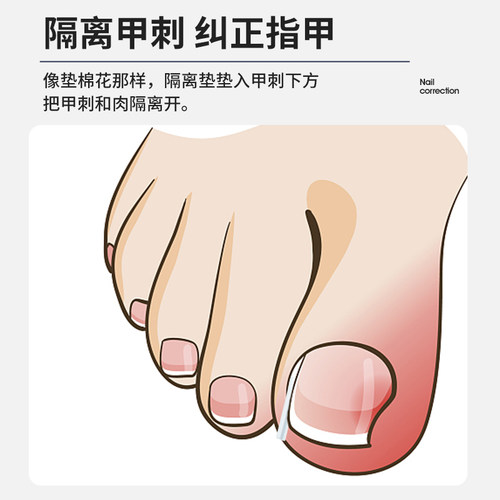 得沃甲沟嵌甲炎指甲填充垫片隔离垫正甲垫炎脚趾甲长到肉里神器垫 - 图2