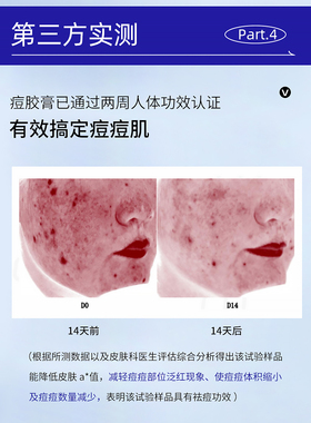 祛痘去粉刺护肤品姗拉娜控油