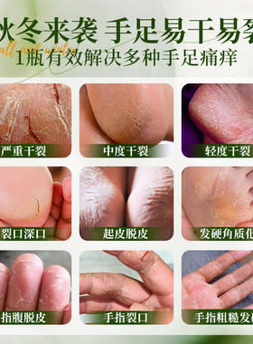 送同款驱蚊贴干裂冻疮南非原产