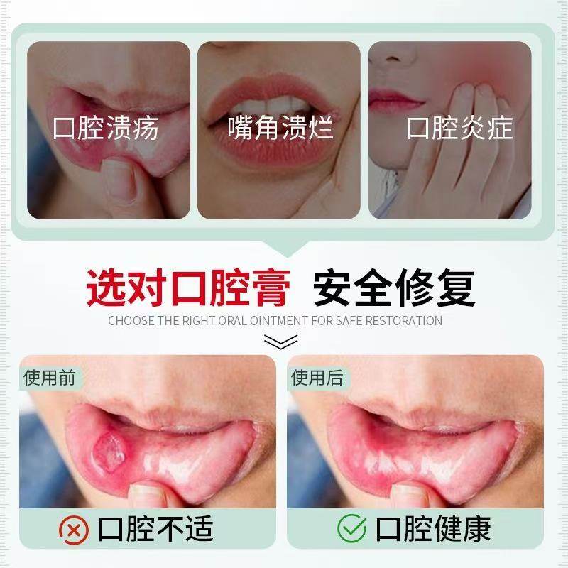 NIDA泰国口腔溃疡凝胶成人儿童口腔溃疡药膏嘴巴上火起泡修复粘膜,淘宝优惠券,粉丝福利购,淘宝优惠卷
