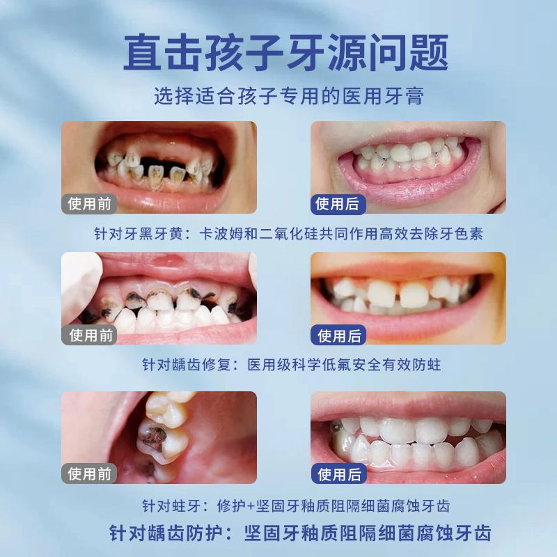 儿童牙膏6一12岁换牙期含氟防蛀龋齿修复3一6去黄去口臭美白抗敏-图0