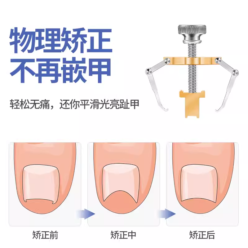 甲沟专用矫正指甲剪刀单个套装家用成人鹰嘴嵌甲修脚神器尖嘴钳炎 - 图3