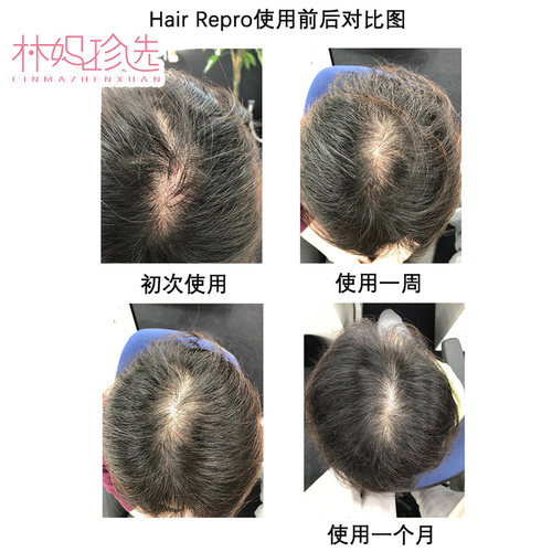 Dr.Arrivo宙斯爱德兰丝头皮护理头盔生长发帽子 LED红光增发防秃 - 图1