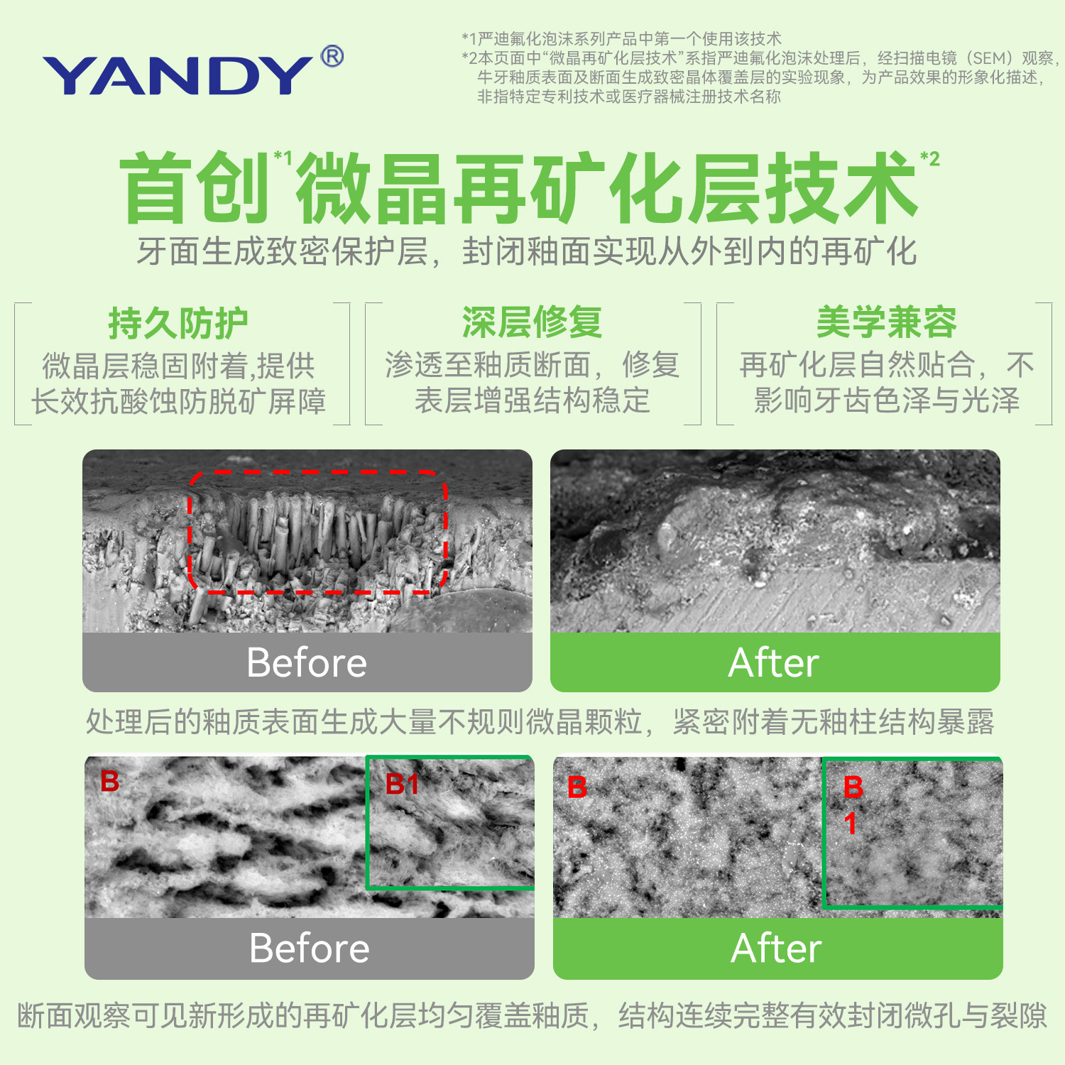 严迪牙齿涂氟剂氟化泡沫儿童成人正畸含氟牙膏医用牙科防蛀保护漆