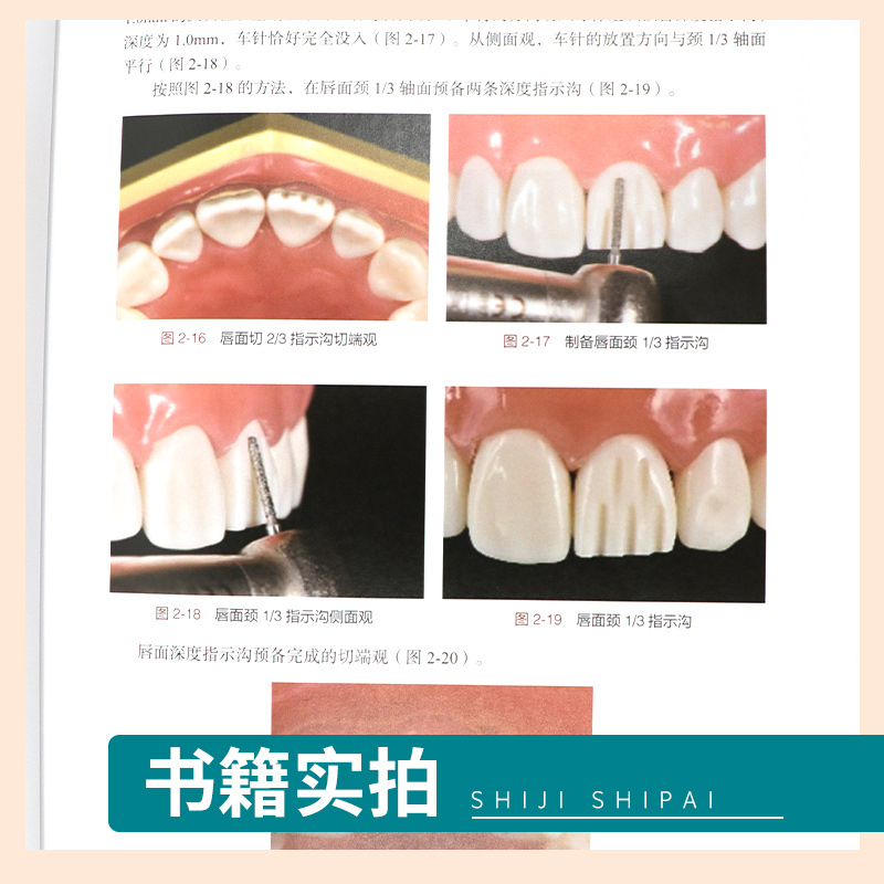 牙体缺损修复备牙过程图解蓝菁林东葛少华编前牙全瓷冠牙体预备开窗型前牙瓷贴面牙体预备科学出版社 9787030673015-图1