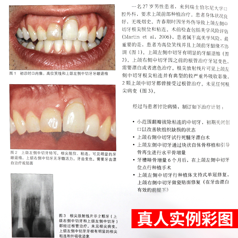 包邮正版国际口腔种植学会（ITI）口腔种植临床指南第七卷腔种植的牙槽嵴骨增量程序：分阶段方案辽宁科学技术出版社-图2