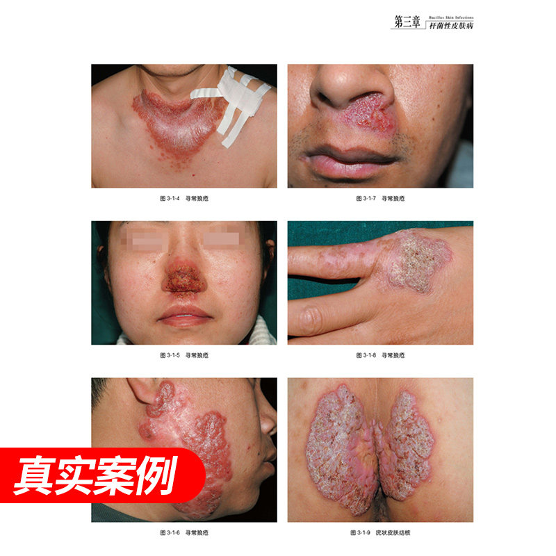 中国皮肤病性病图鉴朱学骏皮肤学 盛世天佑图书皮肤病学/性病学