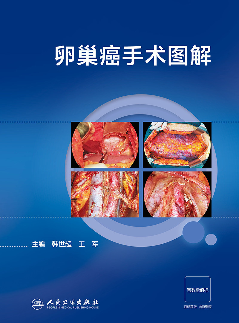 卵巢癌手术图解 人民卫生出版社 韩世超等 肿瘤细胞减灭术 腹主区域融合转移淋巴结切除术 卵巢癌手术相关解剖 阑尾切除术