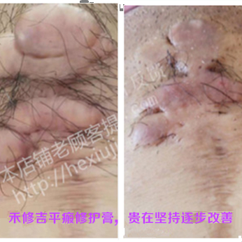 禾修吉疤痕疙瘩疤痕增生红色凸起蟹足肿专用修护膏 - 图1