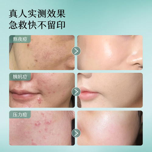 初夏堂小绿灯祛痘精华液面部闭口粉刺舒缓修护淡化青春痘印疤男女 - 图0