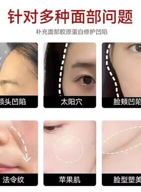 三型胶原蛋白丰泪沟抬头川子法令纹面部细纹眼下额头脸颊提升精致