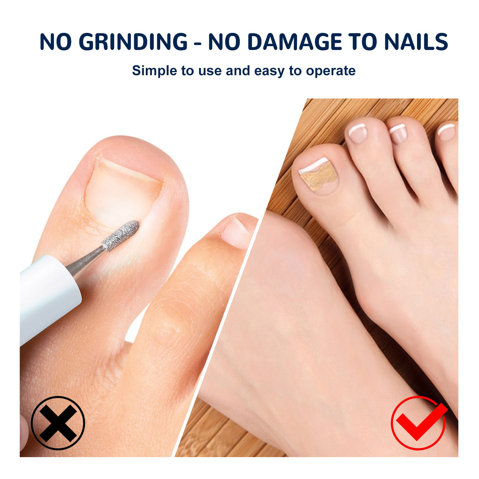 Nail correction patch for manicure and toe repair 修护脚趾 - 图1