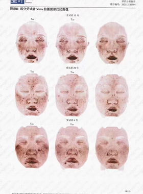 润根源祛痘净颜膏祛痘膏