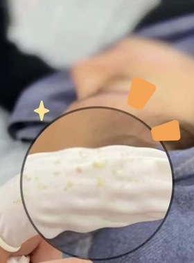 美容院专用去黑头导出精华液收缩毛孔精华溶解软化粉刺小气泡套装