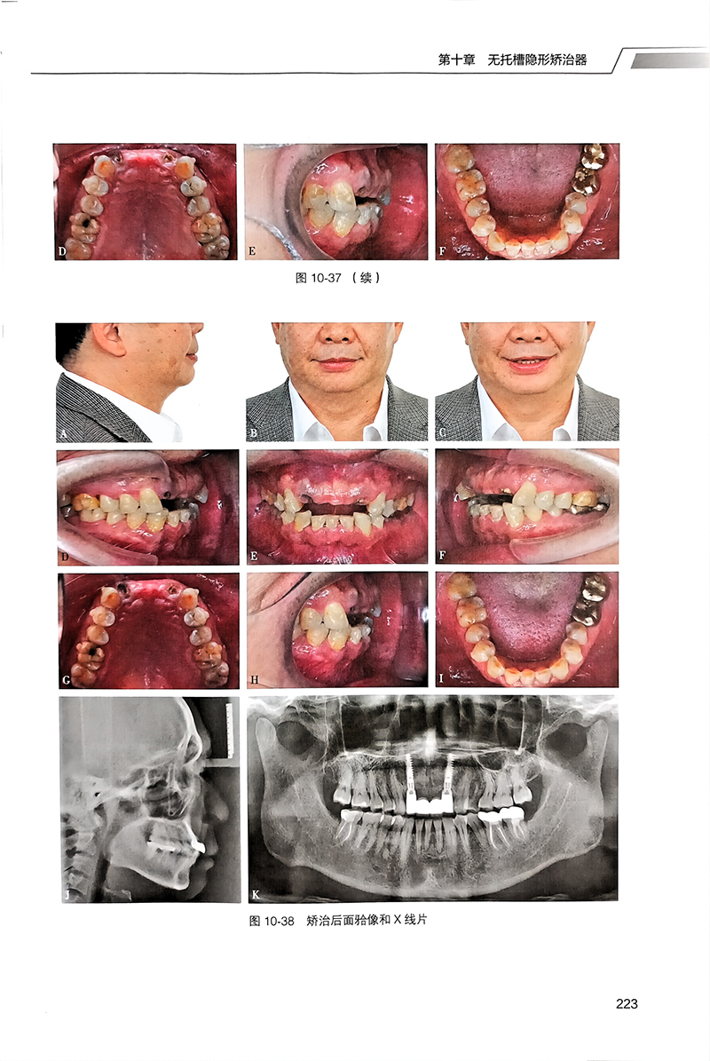 口腔正畸学 李蔚然主编 北大医学研究生规划教材 医师培训参考书 临床诊断矫治技术典型病例解析 北京大学医学出版社9787565927997 - 图3