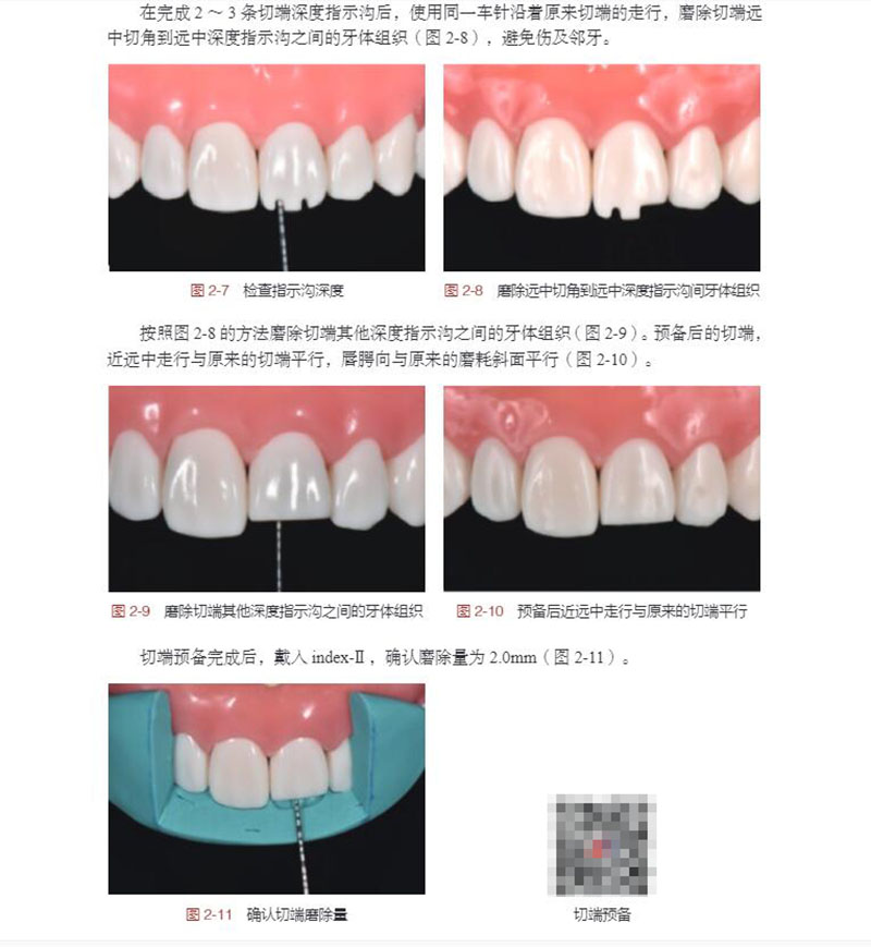 牙体缺损修复备牙过程图解 牙全瓷冠牙体预备 开窗型前牙瓷贴面牙体预备 口腔书 蓝菁 林东 葛少华 9787030673015 科学出版社 - 图3