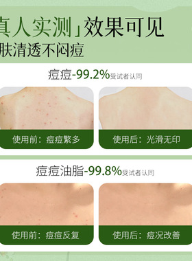 AOPY植萃祛痘身体喷雾男女后背痘祛痘喷剂身体祛痘痘草本祛痘喷雾