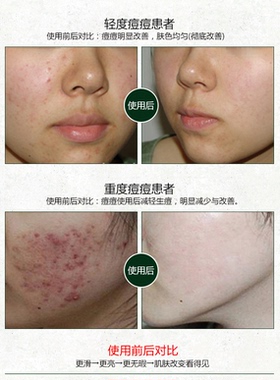 28天暗疮痘痘祛印调理膏德国女孩