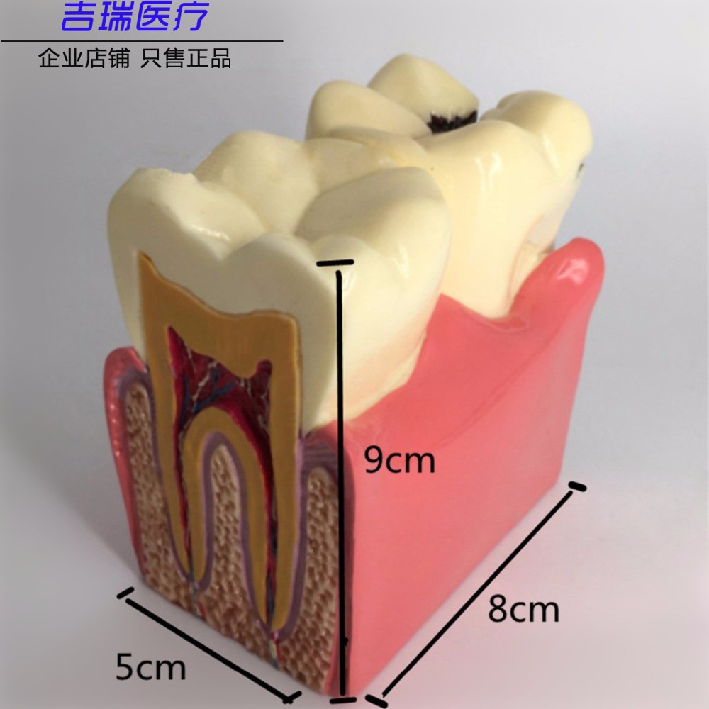 牙科牙齿模型 6倍龋齿对比模型口腔模型医患沟通教学模型包邮-图0